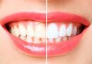 Tandblekning hemma: Guide till Strålande Vita Tänder